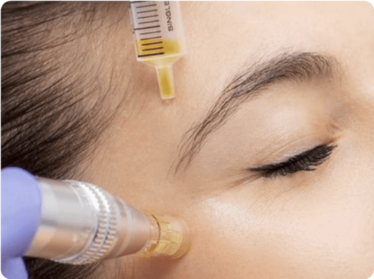 PRP  + Microneedling